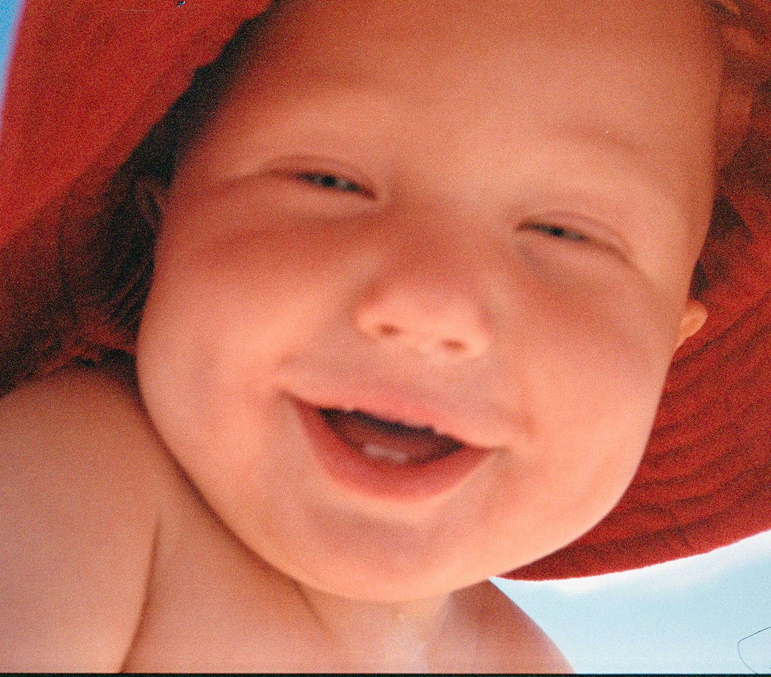 Treating Perioral Dermatitis Naturally